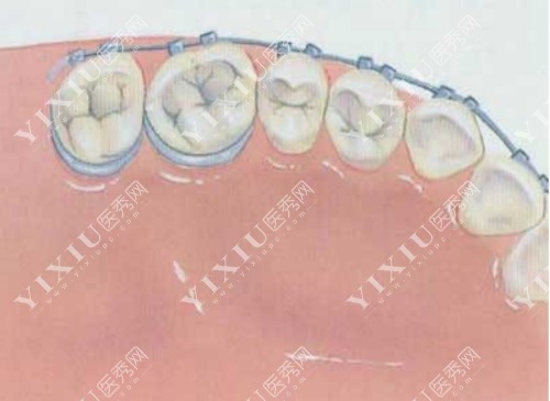 金属托槽正畸示意图