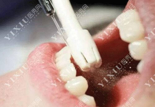 牙齿喷砂洗牙的图片