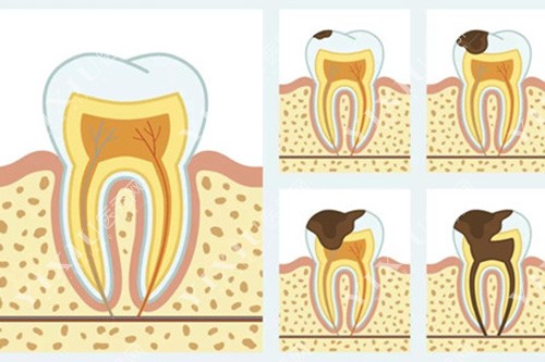 牙齿不同程度龋坏
