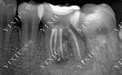 牙齿根管拍片检查的图片