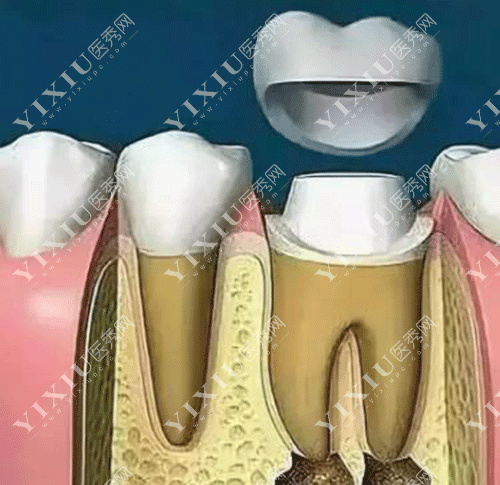 牙齿根管后戴牙冠的图片