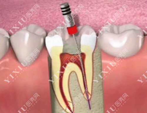 牙齿根管治疗图片
