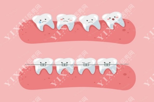 牙齿卡通正畸成果对比图
