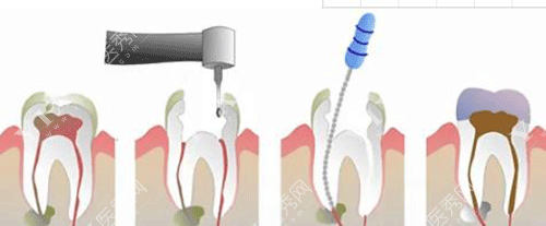 牙齿根管充填的图片