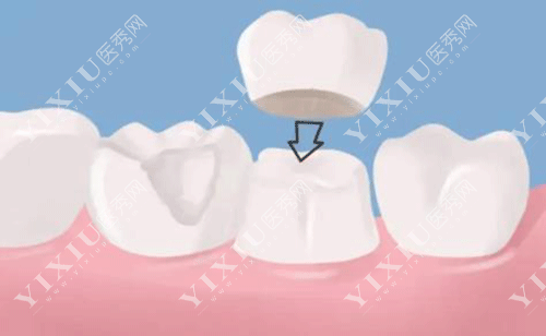 牙齿戴牙冠的图片