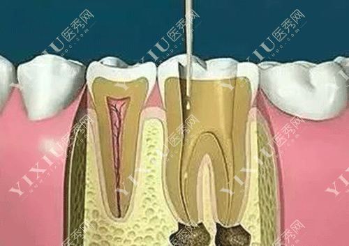 牙齿杀神经治疗牙齿炎症的图片