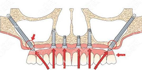 牙齿种植体的植入方向图片