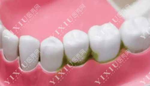 牙齿牙结石的图片