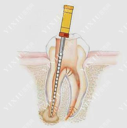 牙齿牙髓炎治疗的图片