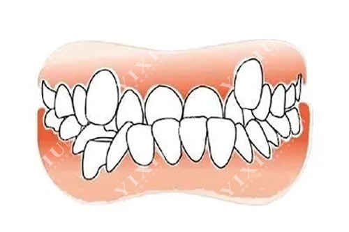 牙齿多生导致拥挤