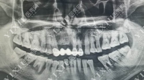 口腔修复治疗ct