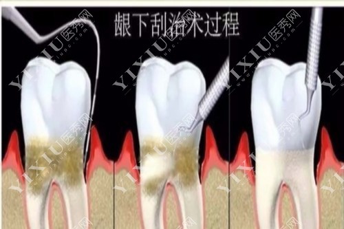 龈下洁治术过程手绘图