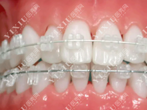 进口金属自锁托槽和陶瓷托槽哪些牌子好用?这份2022进口托槽品牌价格表请收好!(图3) 进口金属自锁托槽和陶瓷托槽哪些牌子好用?这份2022进口托槽品牌价格表请收好!(图3)