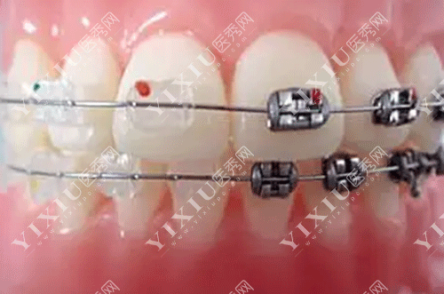 进口金属自锁托槽和陶瓷托槽哪些牌子好用?这份2022进口托槽品牌价格表请收好!(图4) 进口金属自锁托槽和陶瓷托槽哪些牌子好用?这份2022进口托槽品牌价格表请收好!(图4)