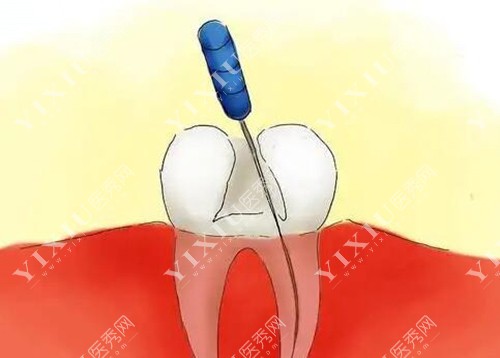 牙齿根管治疗展示图