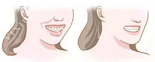 蚌埠牙齿矫正价格多少钱？更新蚌埠牙齿矫正收费明细(图4)