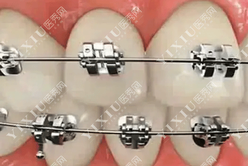 进口金属自锁托槽和陶瓷托槽哪些牌子好用?这份2022进口托槽品牌价格表请收好!(图5) 进口金属自锁托槽和陶瓷托槽哪些牌子好用?这份2022进口托槽品牌价格表请收好!(图5)