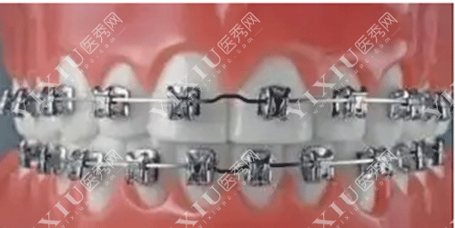 进口金属自锁托槽和陶瓷托槽哪些牌子好用?这份2022进口托槽品牌价格表请收好!(图2) 进口金属自锁托槽和陶瓷托槽哪些牌子好用?这份2022进口托槽品牌价格表请收好!(图2)