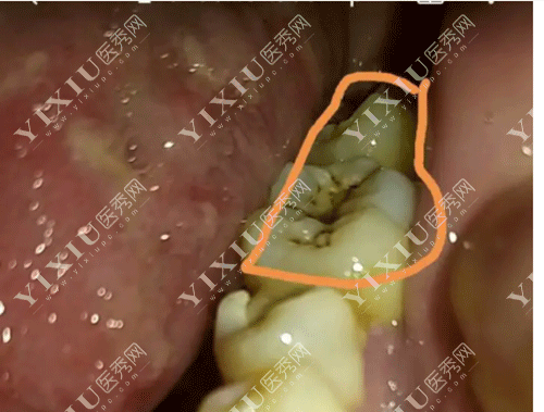 牙齿后牙有蛀牙图片