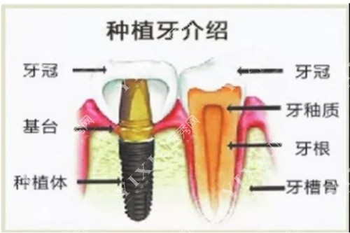 种植牙介绍示意图