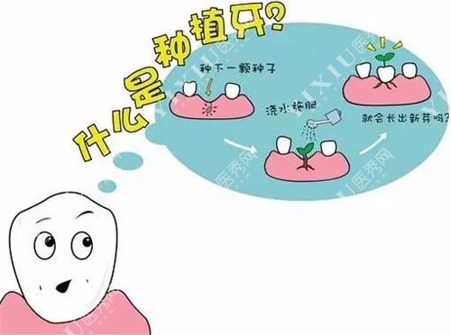 吉林市种植牙示意图