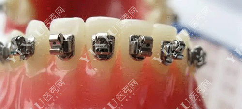 进口金属自锁托槽和陶瓷托槽哪些牌子好用?这份2022进口托槽品牌价格表请收好!(图6) 进口金属自锁托槽和陶瓷托槽哪些牌子好用?这份2022进口托槽品牌价格表请收好!(图6)