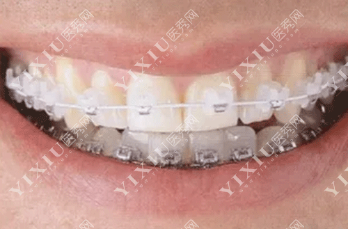 进口金属自锁托槽和陶瓷托槽哪些牌子好用?这份2022进口托槽品牌价格表请收好!(图8) 进口金属自锁托槽和陶瓷托槽哪些牌子好用?这份2022进口托槽品牌价格表请收好!(图8)