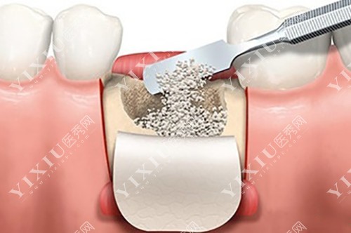 植骨操作示意图