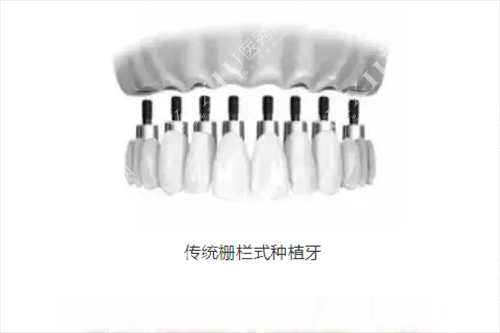 传统栅栏式种植牙