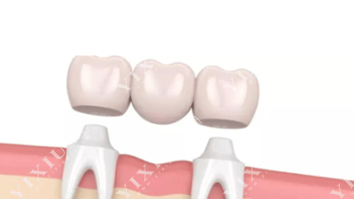 牙齿固定桥修复的图片