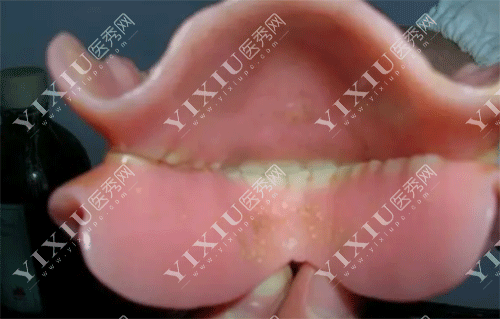 牙齿树脂假牙磨损的图片