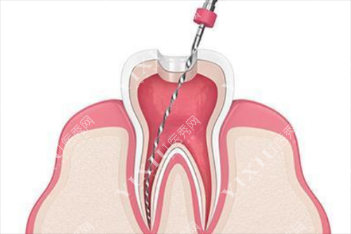 根管治疗示意图