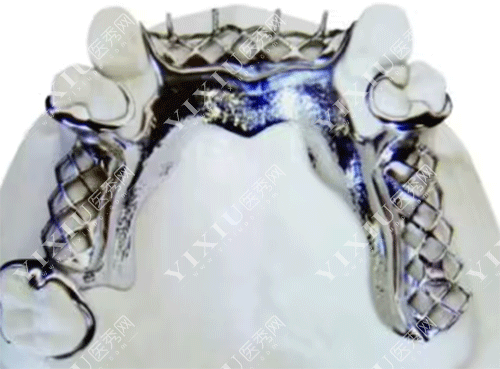 牙齿金属支架的安装图片