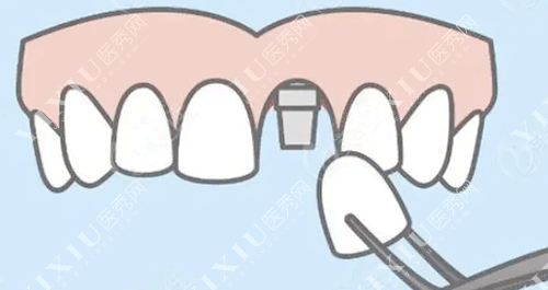 牙齿种牙装牙冠的图片