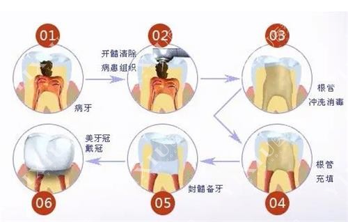 吉林市壹舟根管治疗示意图