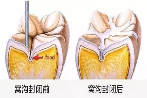 窝沟封闭前后对比