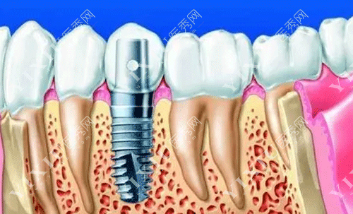 选假牙不纠结:固定牙与种植牙哪个好?有啥区别?(图5) 选假牙不纠结:固定牙与种植牙哪个好?有啥区别?(图5)