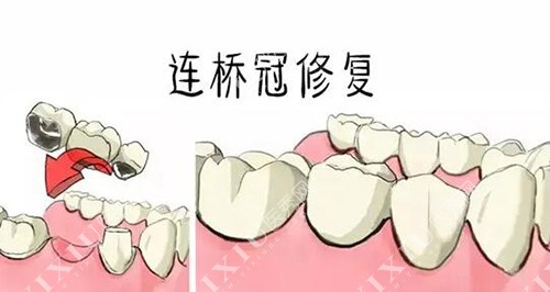 连桥牙冠修复改善治疗