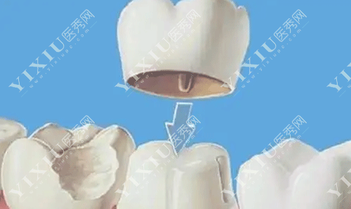 选假牙不纠结:固定牙与种植牙哪个好?有啥区别?(图2) 选假牙不纠结:固定牙与种植牙哪个好?有啥区别?(图2)