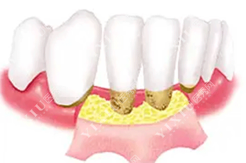 牙齿牙周病治疗的图片