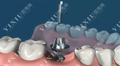选假牙不纠结:固定牙与种植牙哪个好?有啥区别?(图6) 选假牙不纠结:固定牙与种植牙哪个好?有啥区别?(图6)