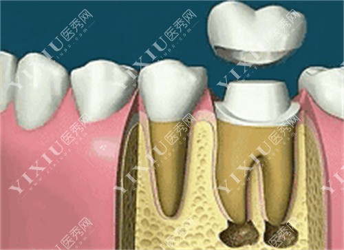 牙齿根管治疗的图片
