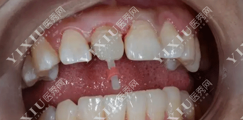 门牙松动了能恢复吗可以固定吗 ?多少钱?(图2) 门牙松动了能恢复吗可以固定吗 ?多少钱?(图2)