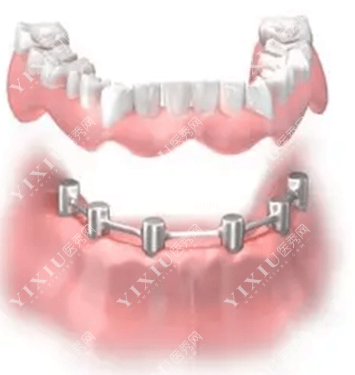 牙齿半口半固定种植的图片