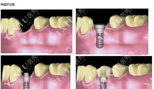 即刻种植牙示意图