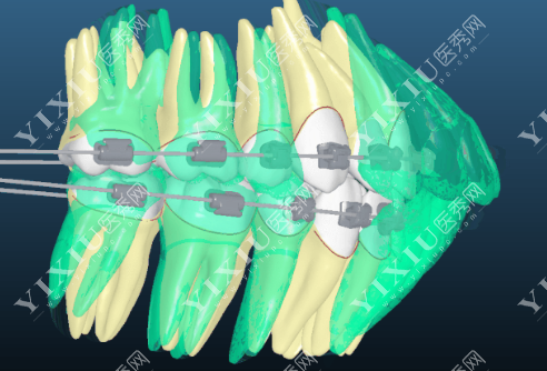 牙齿数字化正畸方案设计的图片