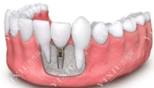 门牙松动了能恢复吗可以固定吗 ?多少钱?(图7) 门牙松动了能恢复吗可以固定吗 ?多少钱?(图7)