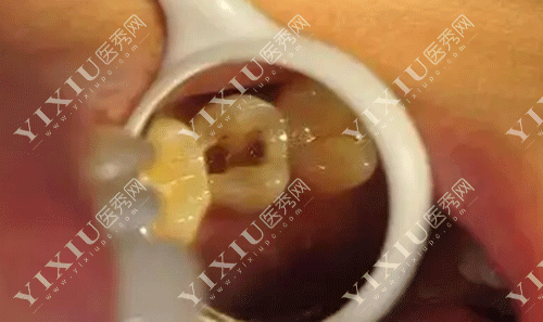 矫正牙齿医生说牙缝关不上怎么回事?科普正畸牙缝关不上原因!(图3) 矫正牙齿医生说牙缝关不上怎么回事?科普正畸牙缝关不上原因!(图3)