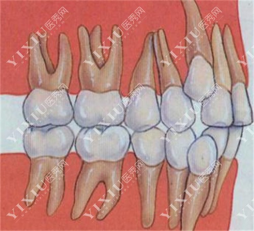 牙齿不整齐的图片