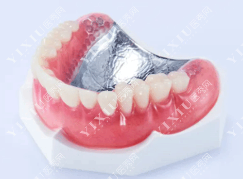 半口牙镶牙需要多少钱?详解传统假牙和吸附性义齿制作流程及区别!